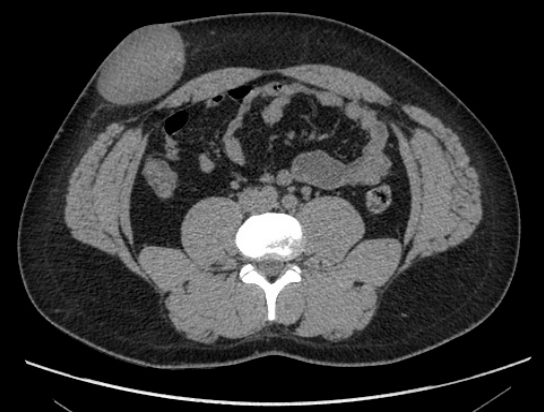 Schwannome de la paroi abdominale